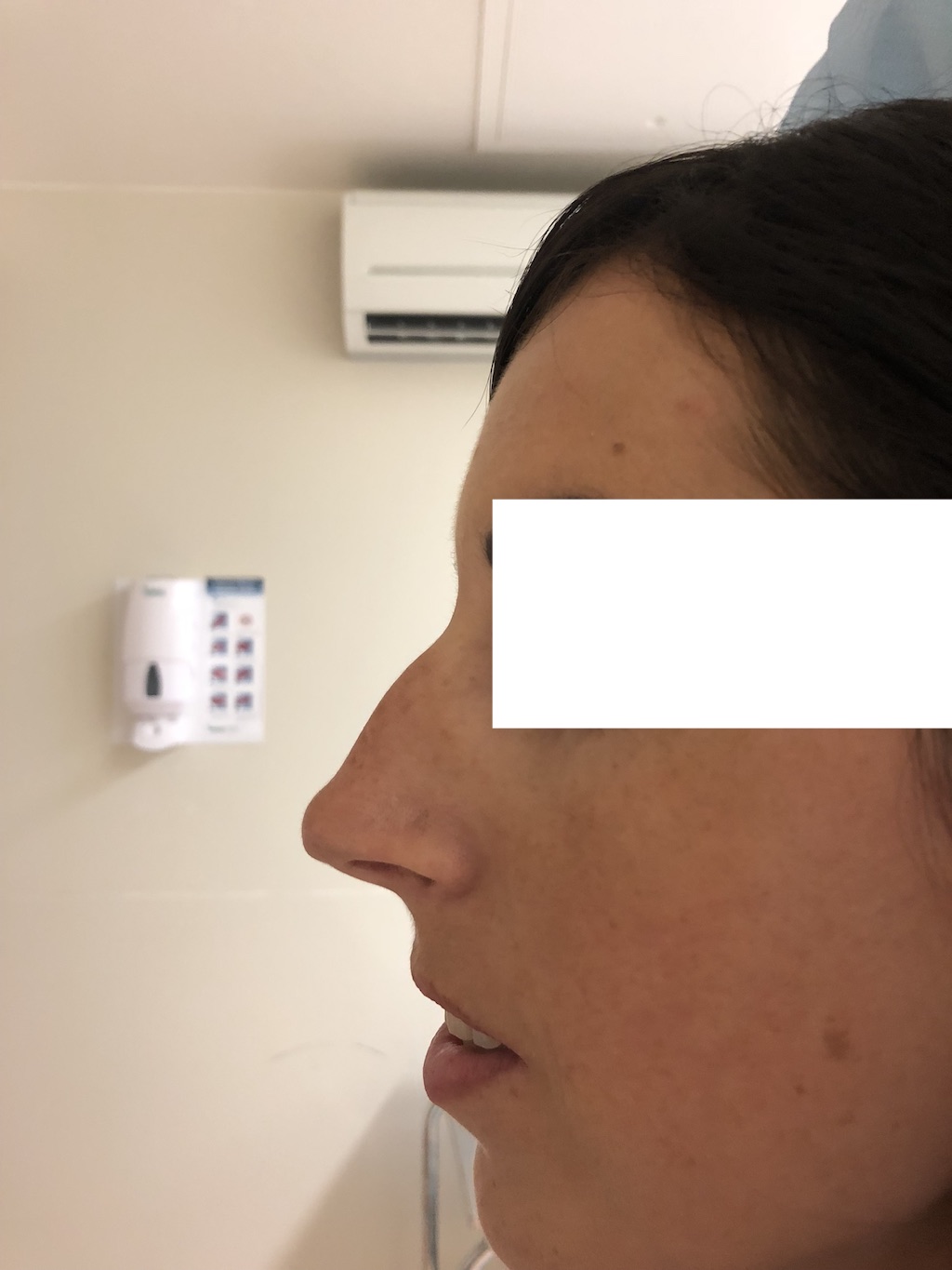 Avant Rhinoplastie par acide hyaluronique en 5 mn à Rennes